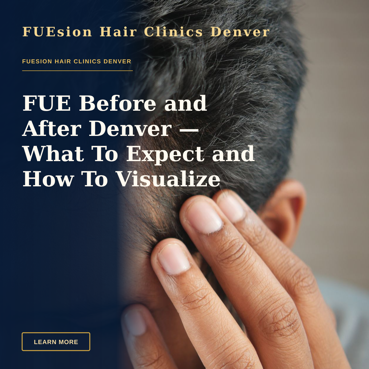 FUE Before and After Denver — What To Expect and How To Visualize Results — Close-up of a man's hand touching his head in contemplation. Neutral tones and soft lighting.