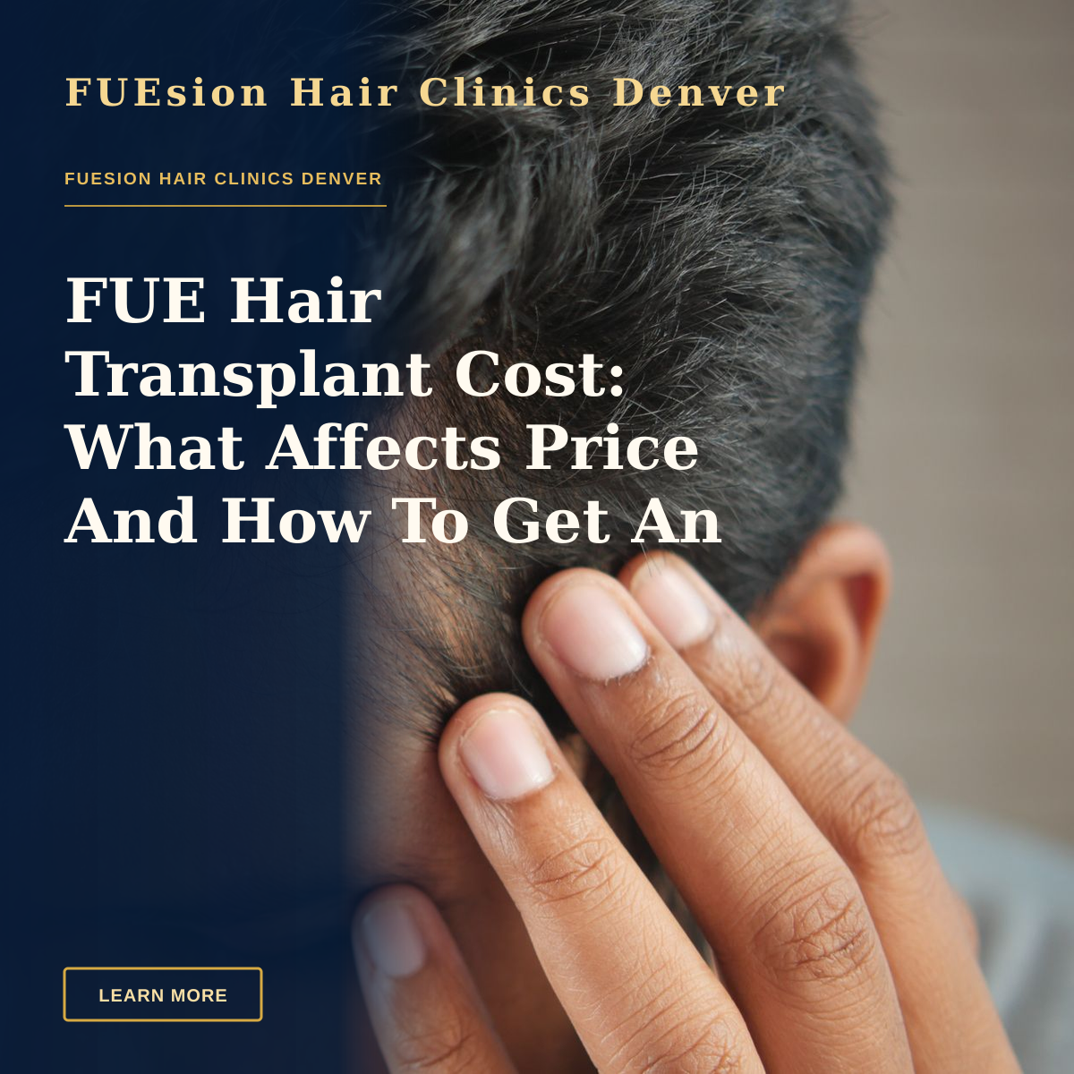 FUE Hair Transplant Cost: What Affects Price And How To Get An Estimate — Close-up of a man's hand touching his head in contemplation. Neutral tones and soft lighting.
