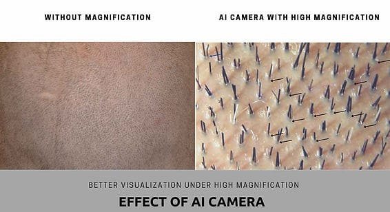 Donor area without magnification versus the HARRTS AI camera under high magnification
