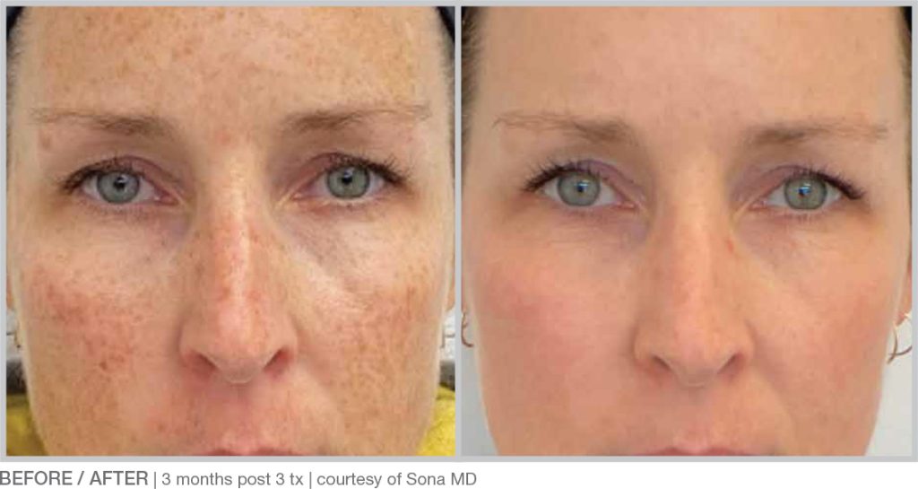 BBL Hero Before & After Results