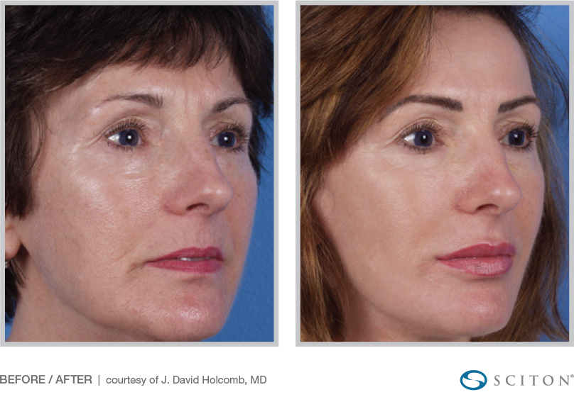 Micro Laser Peel before after