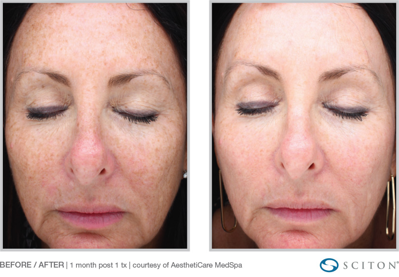 HALO Laser Treatment