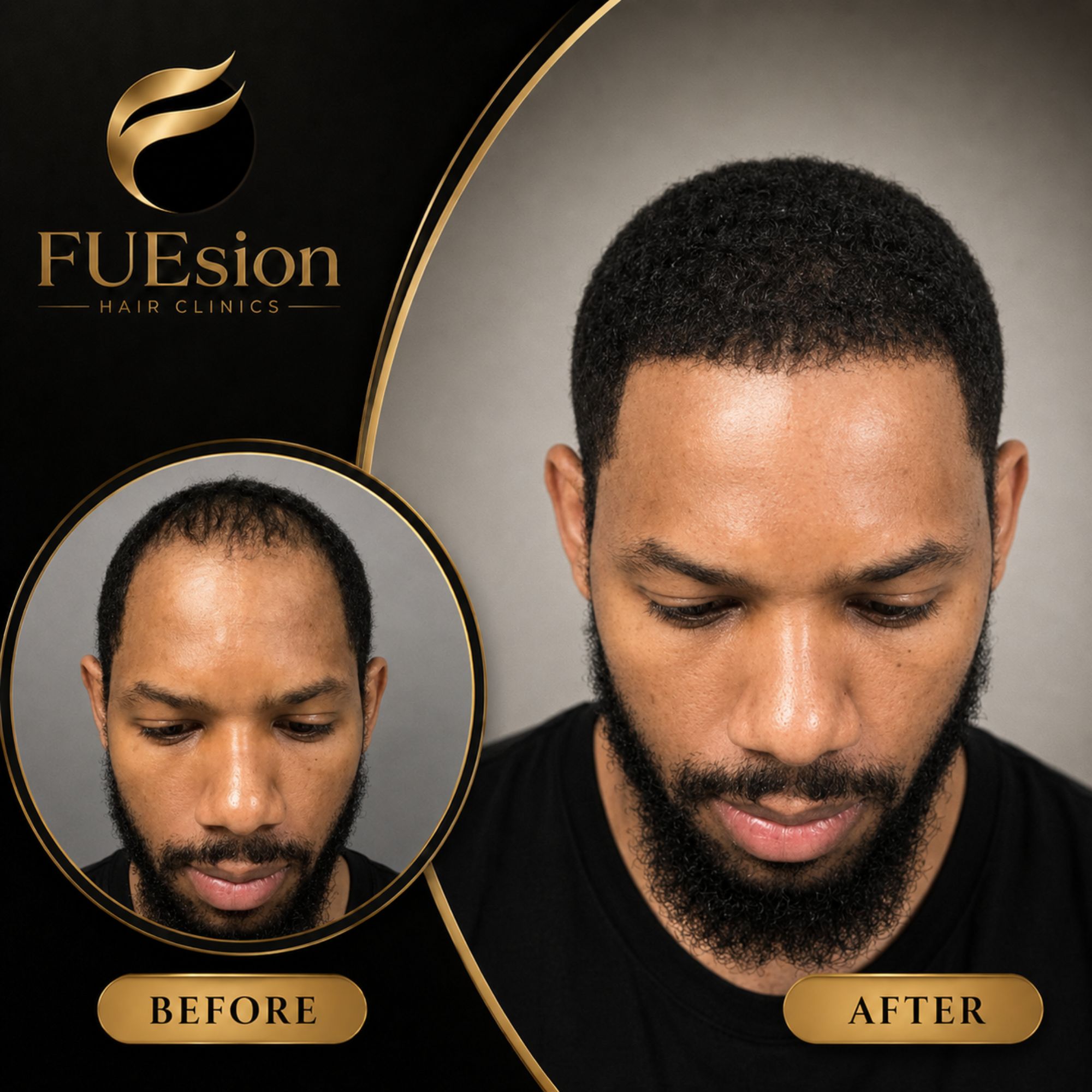 FUE hair transplant before and after showcasing significant hair restoration results — FUEsion Hair Clinics