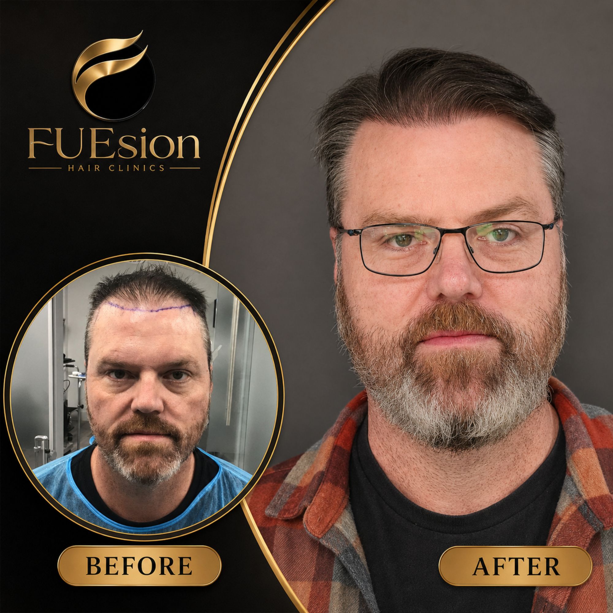 FUEsion patient — I Got My Hair Back With FUEsion