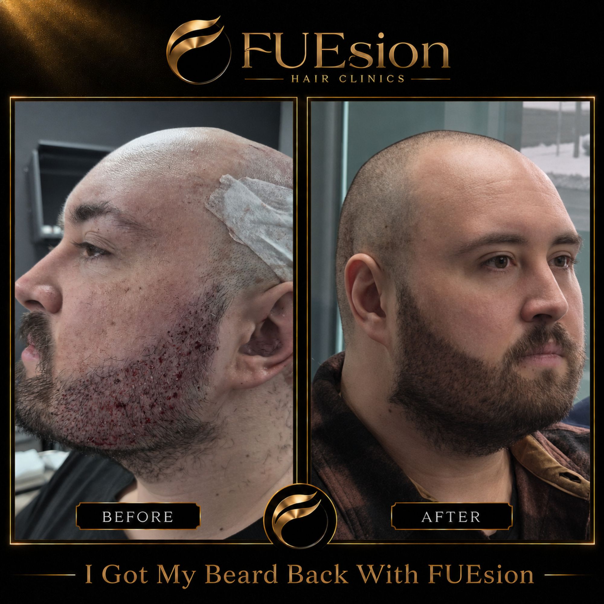 FUE beard transplant before and after — significant beard restoration results at FUEsion Hair Clinics