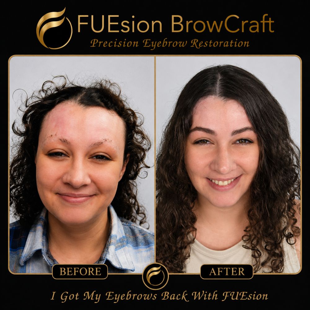 Female hair transplant before and after demonstrating enhanced hair density and style — FUEsion Hair Clinics