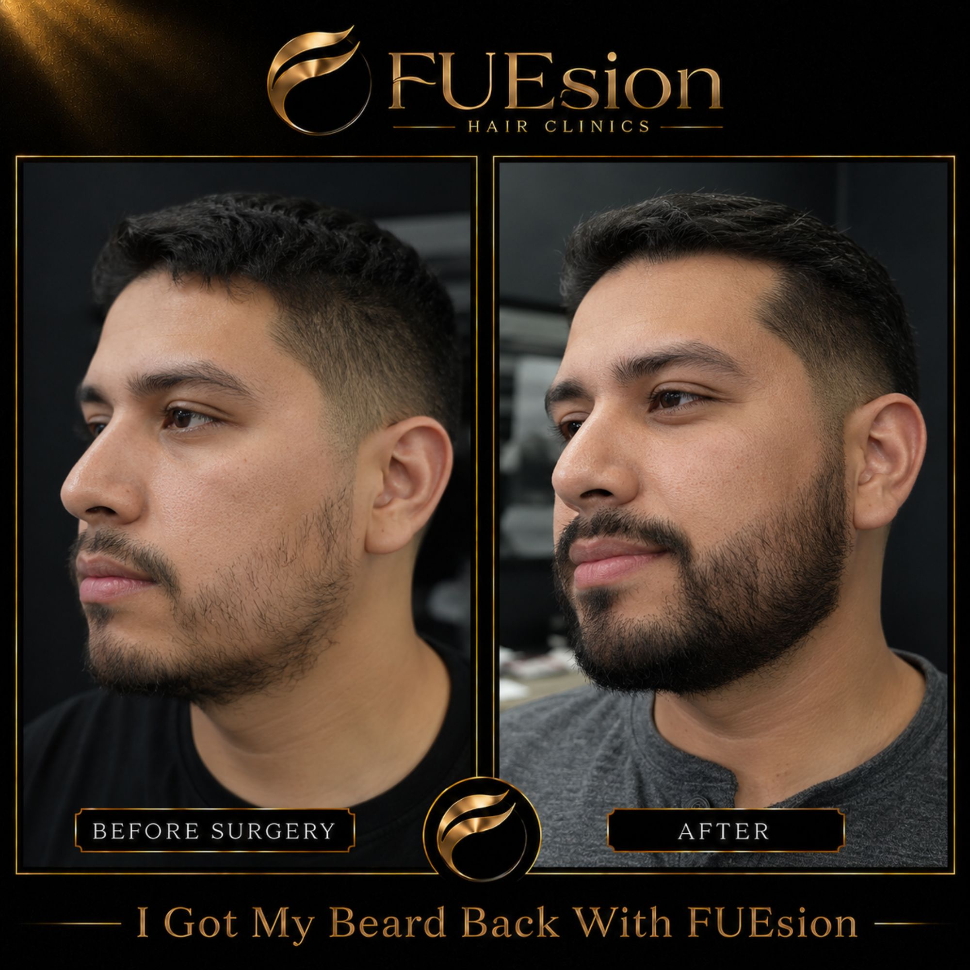 Beard transplant before and after showing significant hair growth and improved fullness — FUEsion Hair Clinics