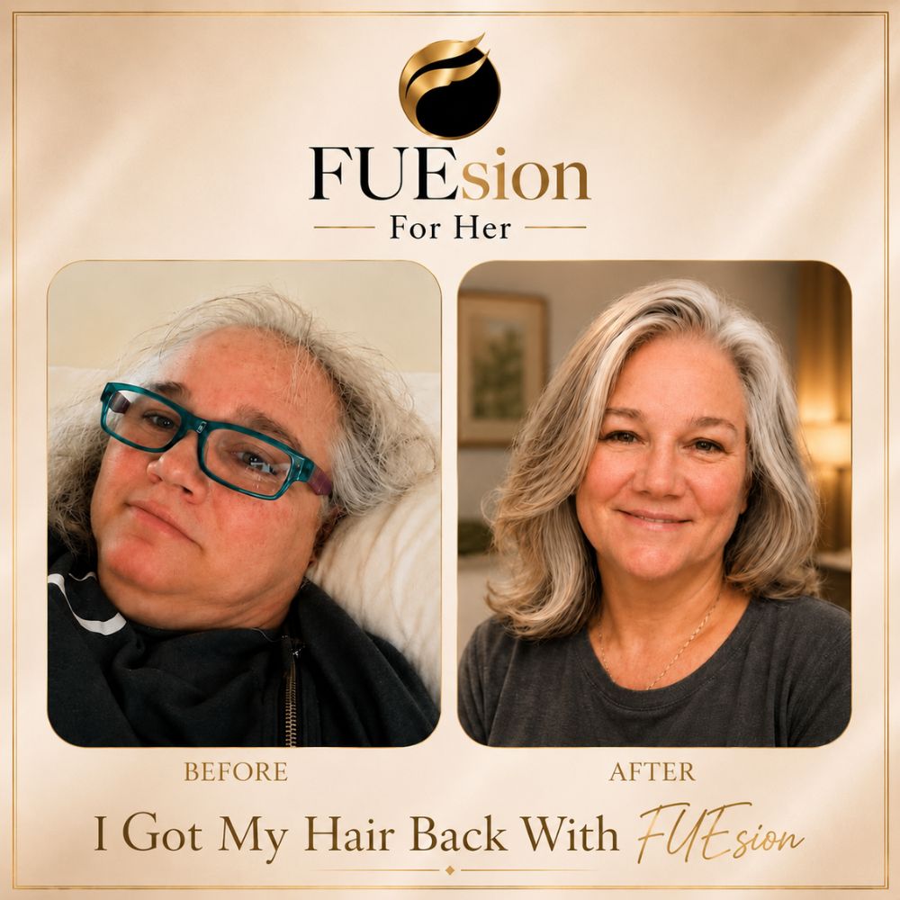 Transformation of eyebrows before and after transplant illustrating enhanced fullness and definition — FUEsion
