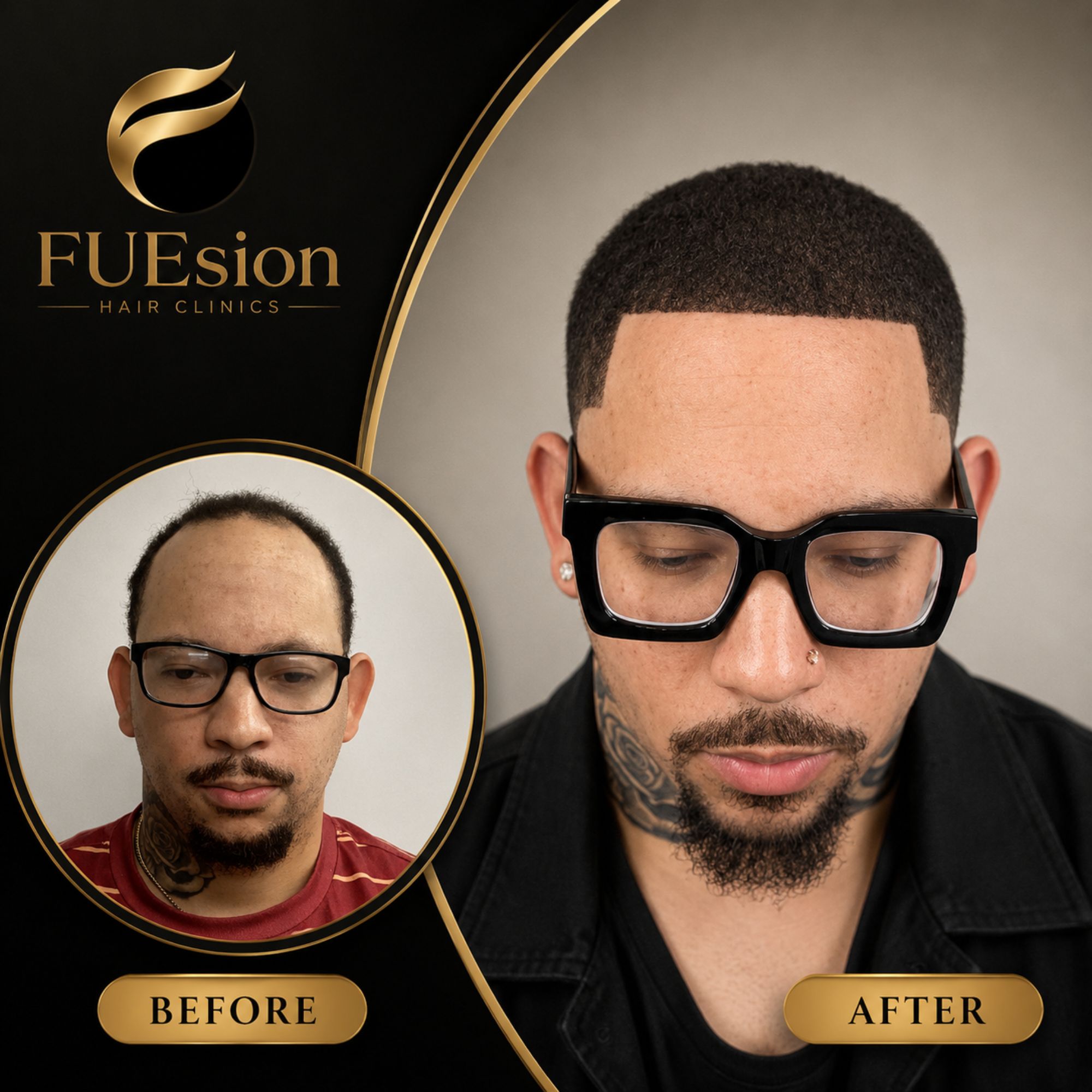 Male hair transplant before and after showcasing rejuvenated hairline with FUEsion Hair Clinics
