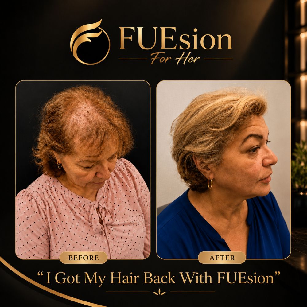 Female hair transplant before and after highlighting restored volume and coverage — FUEsion Hair Clinics
