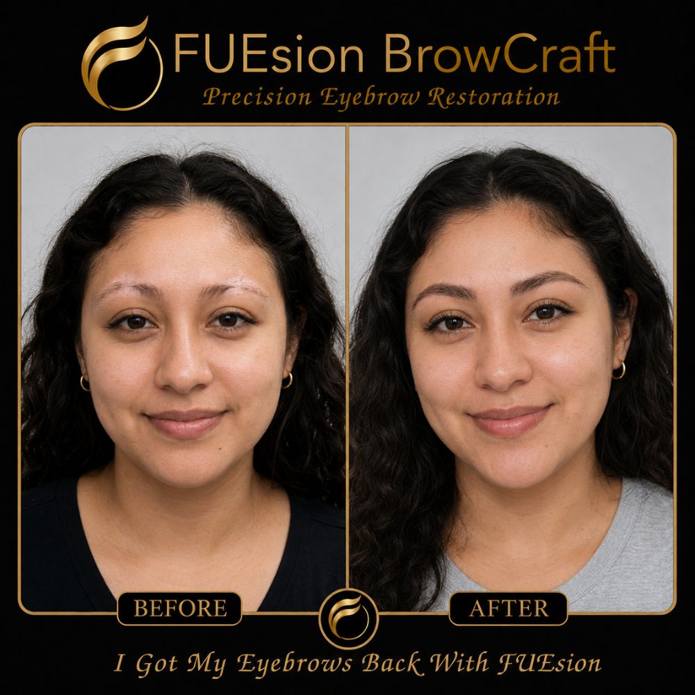 FUE hair transplant before and after showcasing non-surgical hair restoration results from InFuze at FUEsion