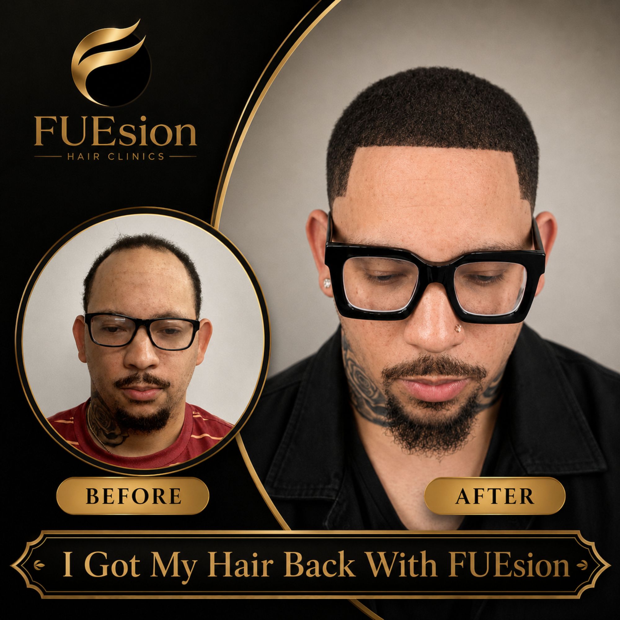 Hair transplant before and after — FUEsion patient demonstrating a fuller hairline at 3 months post-op.