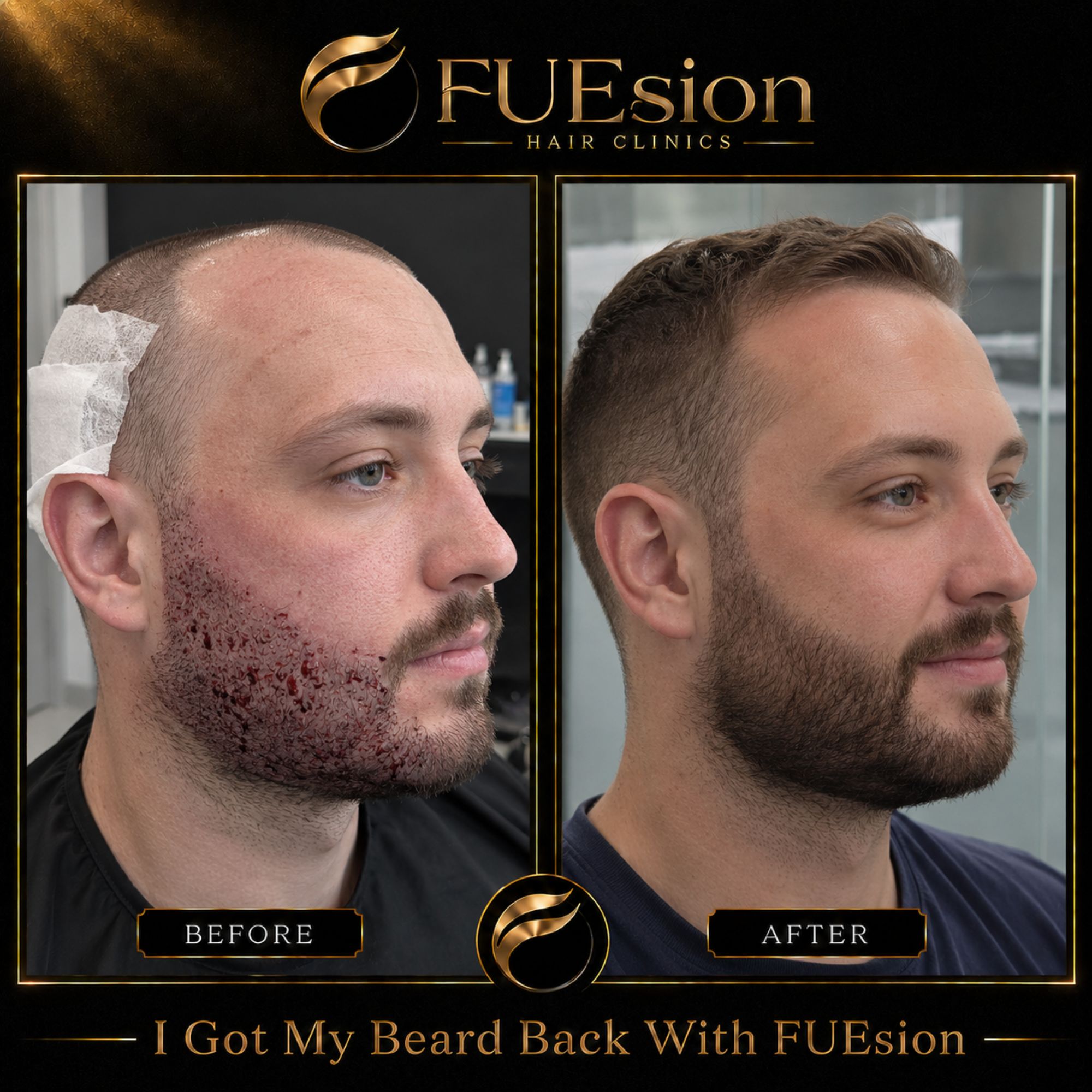 Beard transplant before and after side profile — comparison of beard growth at FUEsion
