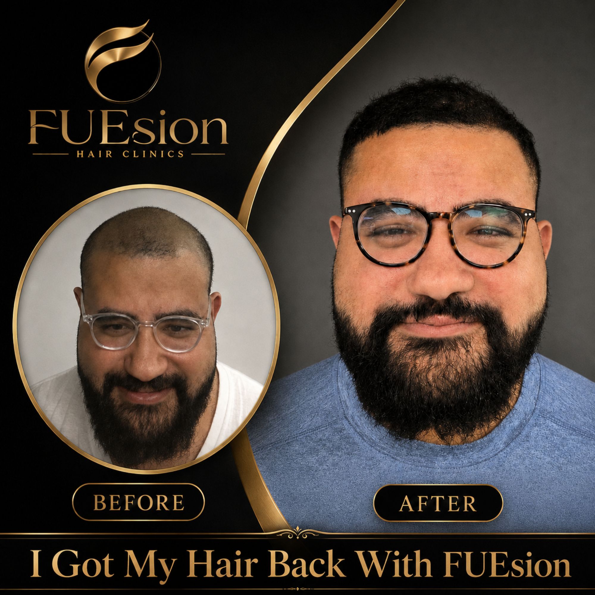 Hair transplant before and after — FUEsion patient showcasing significant hair regrowth at 6 months.