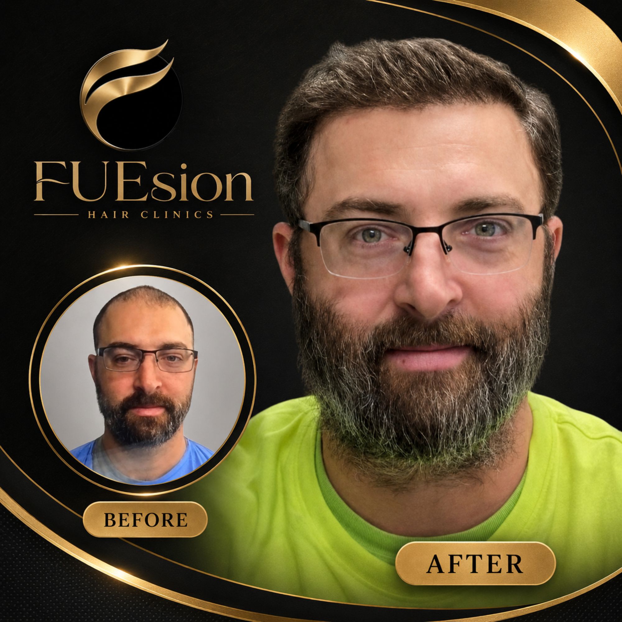FUEsion patient — I Got My Beard Back With FUEsion