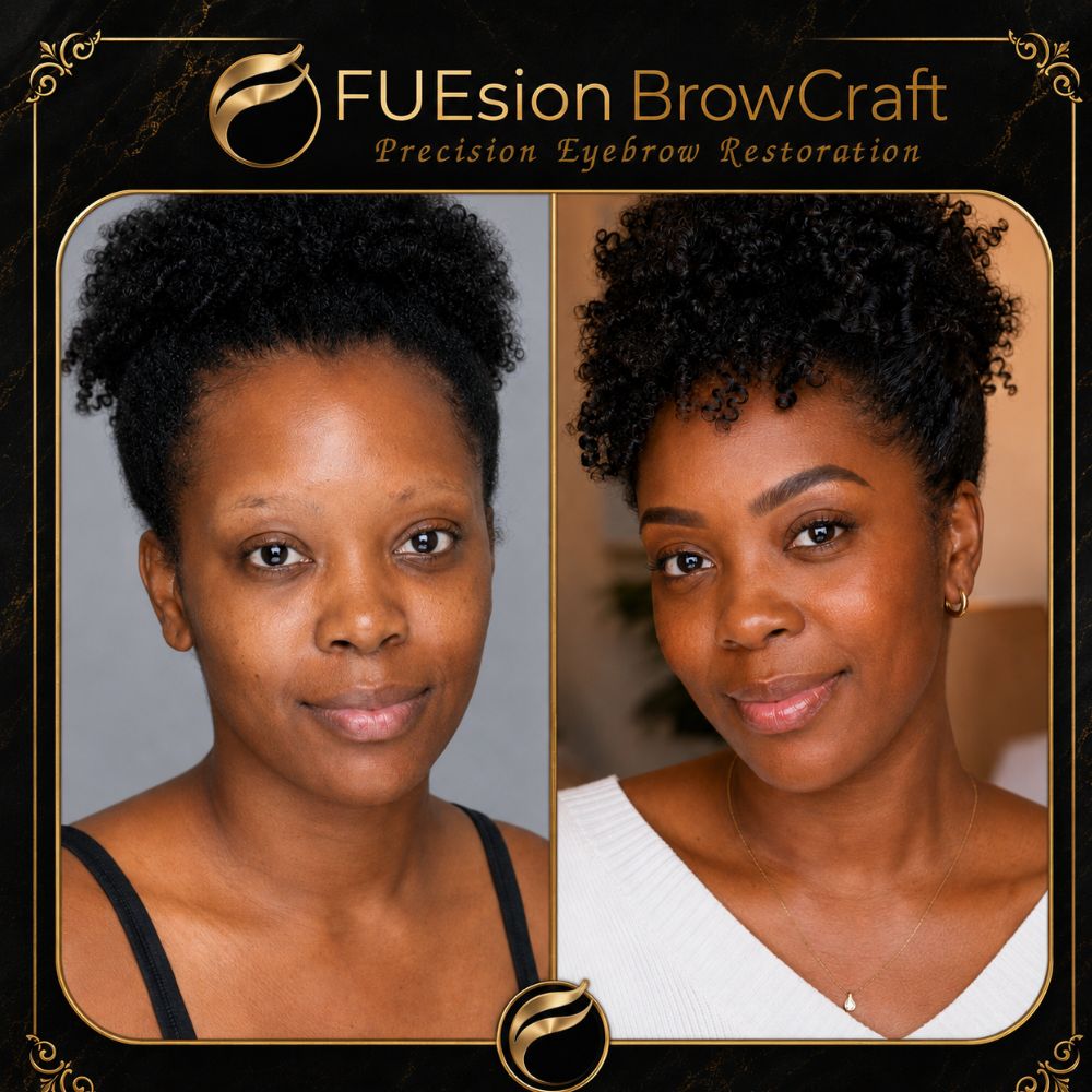 Eyebrow transplant patient result — full brow restoration, FUEsion Hair Clinics