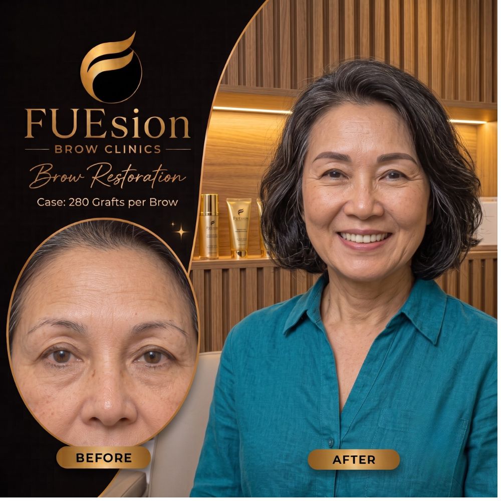 FUE hair transplant before and after — female patient result showing significant hair restoration at FUEsion Hair Clinics