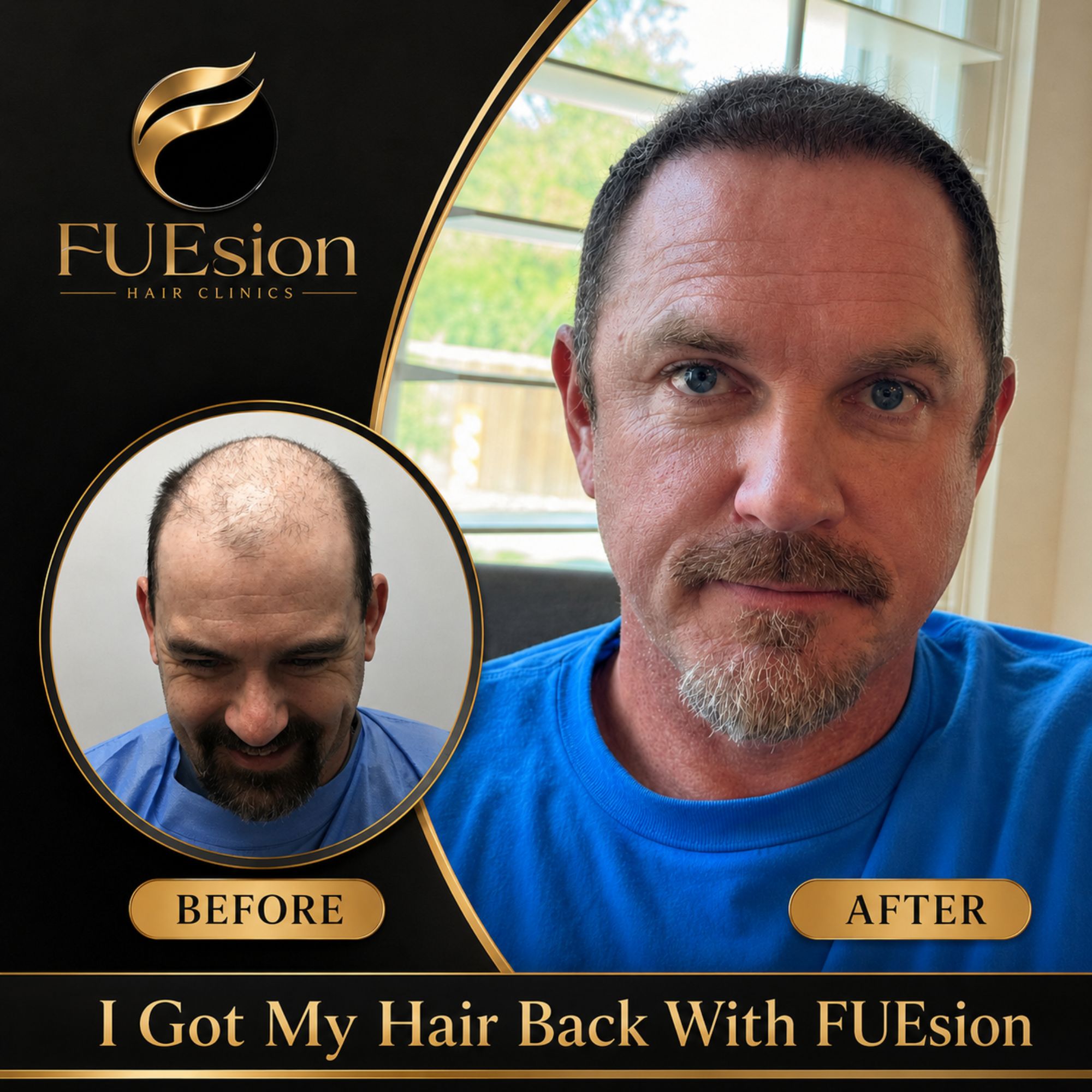 FUE hair transplant before and after — man displaying framed before-and-after image of his hair restoration journey with FUEsion