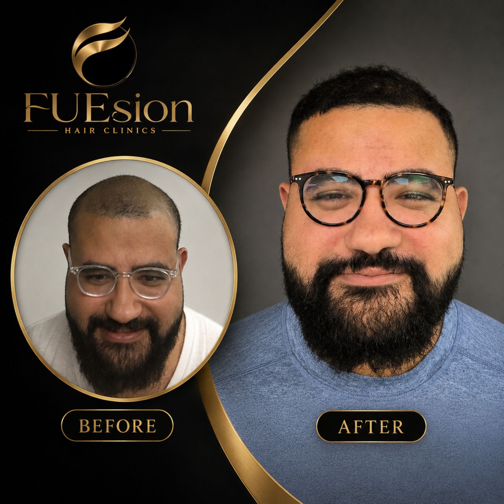FUE hair transplant before and after highlighting improved hairline and volume — FUEsion Hair Clinics