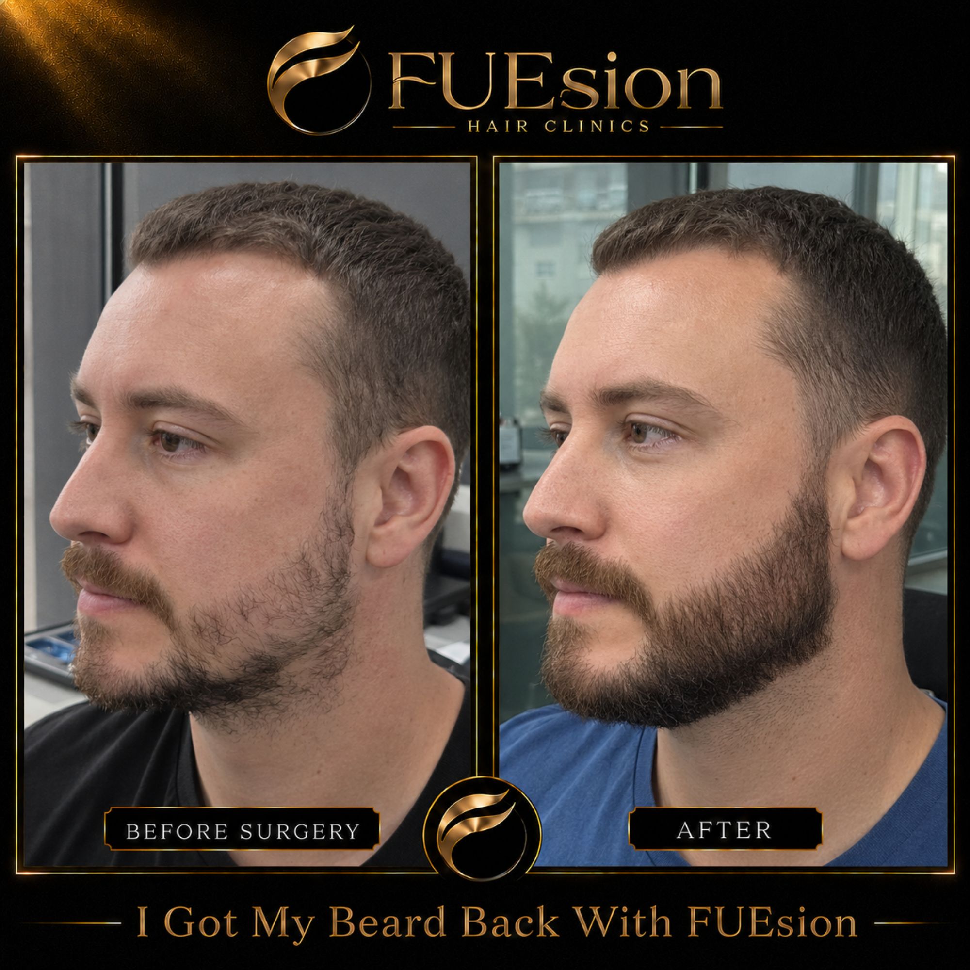 Beard transplant before and after images — enhanced facial hair results at FUEsion Hair Clinic