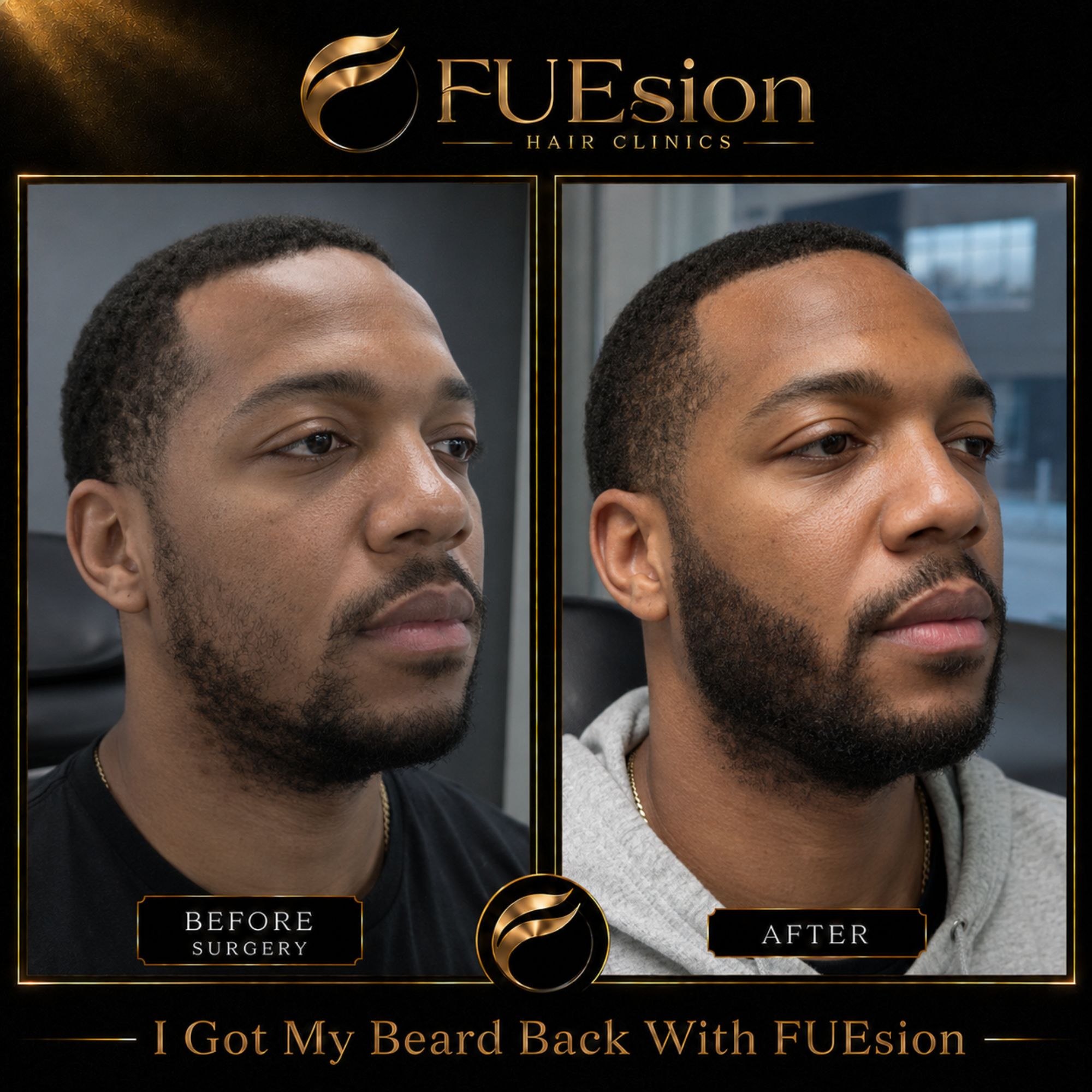FUE beard hair transplant before and after comparison — successful restoration using AI & AR at FUEsion