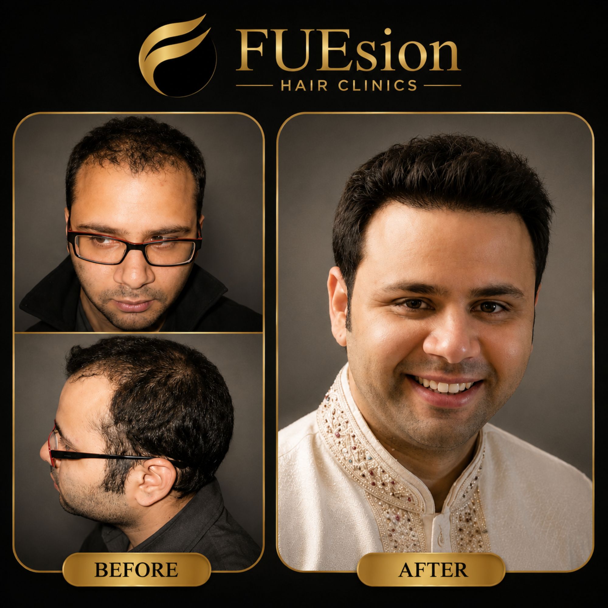 FUEsion patient — I Got My Hair Back With FUEsion