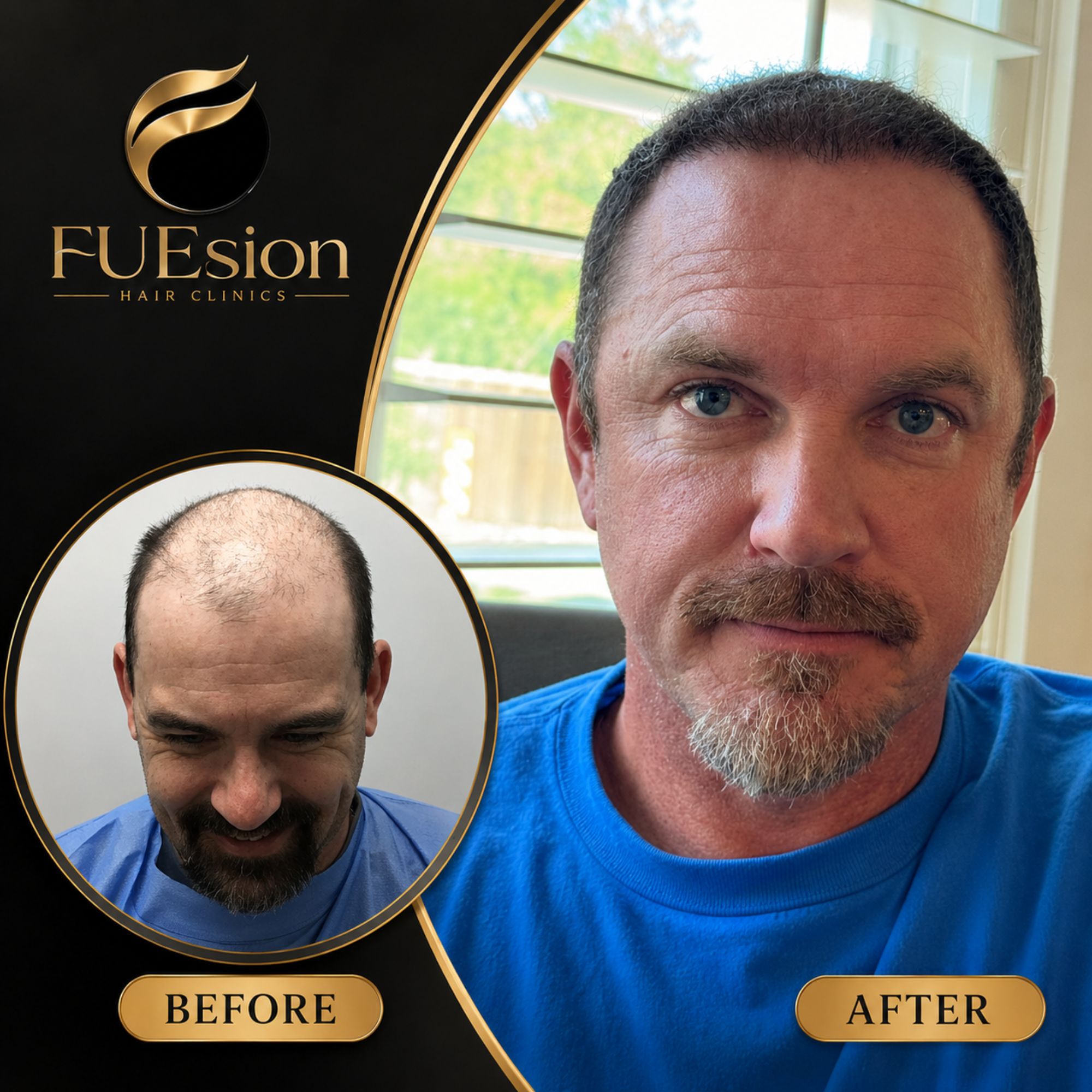 FUE hair transplant before and after depicting enhanced hair density results — FUEsion Hair Clinics
