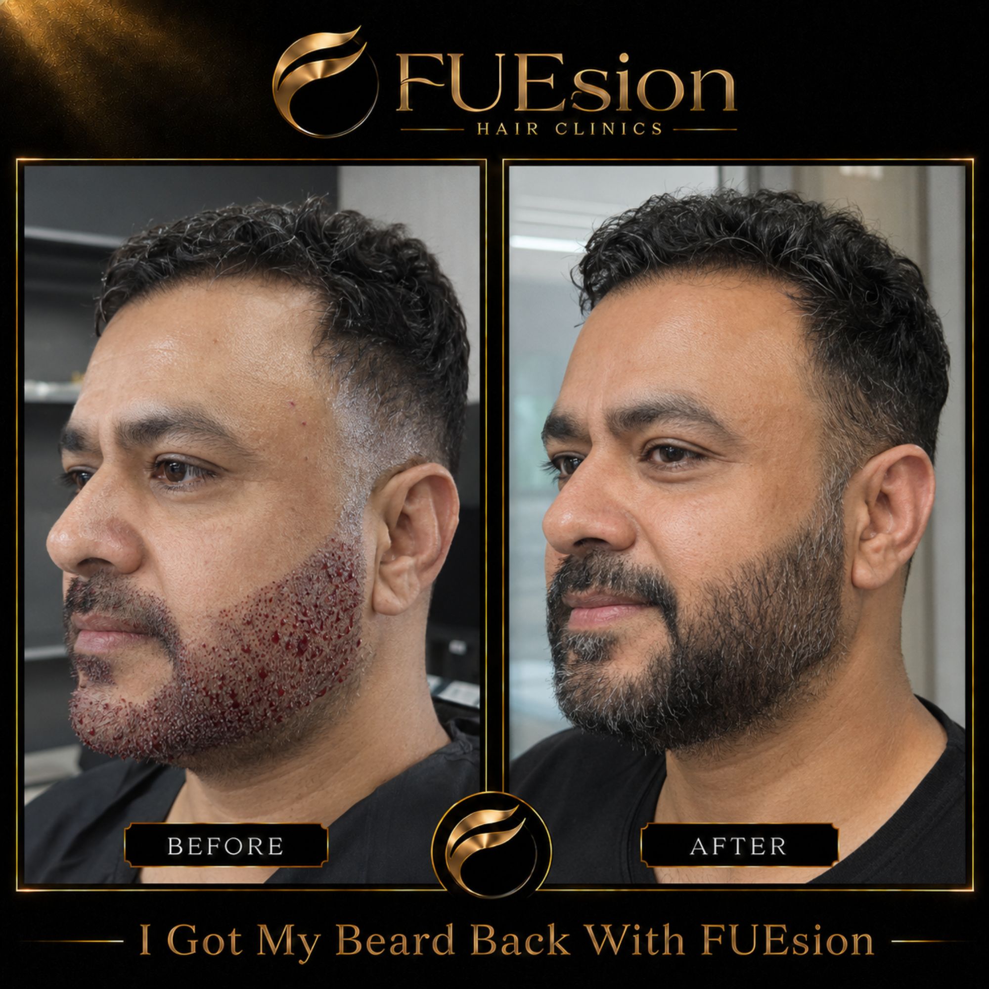 FUE beard hair transplant before and after transformation — beard restoration results at FUEsion Hair Clinics