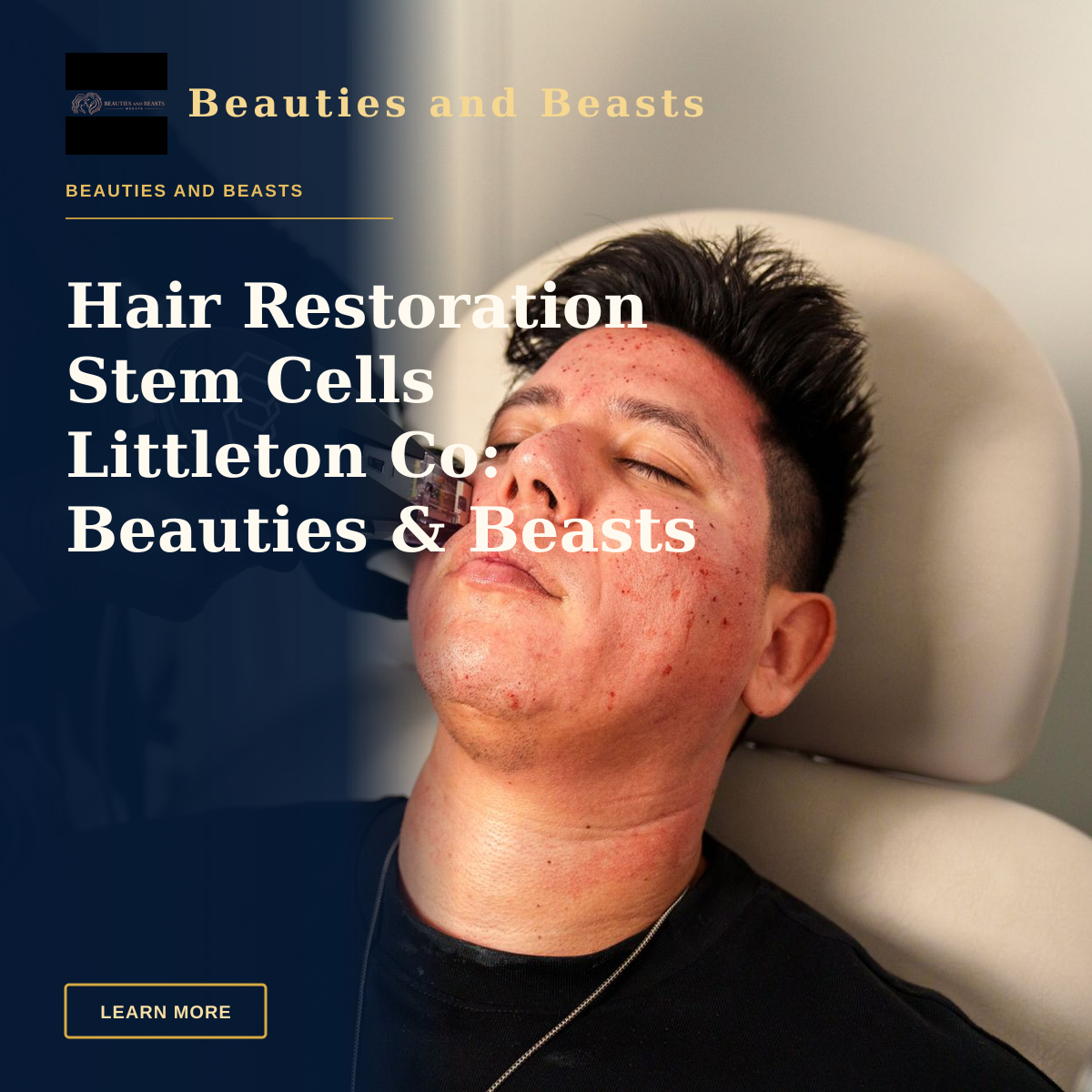 Hair Restoration Stem Cells Littleton Co: Beauties & Beasts Med Spa — Man receives Morpheus8 facial treatment in Santa Ana med spa for skincare rejuvenation.