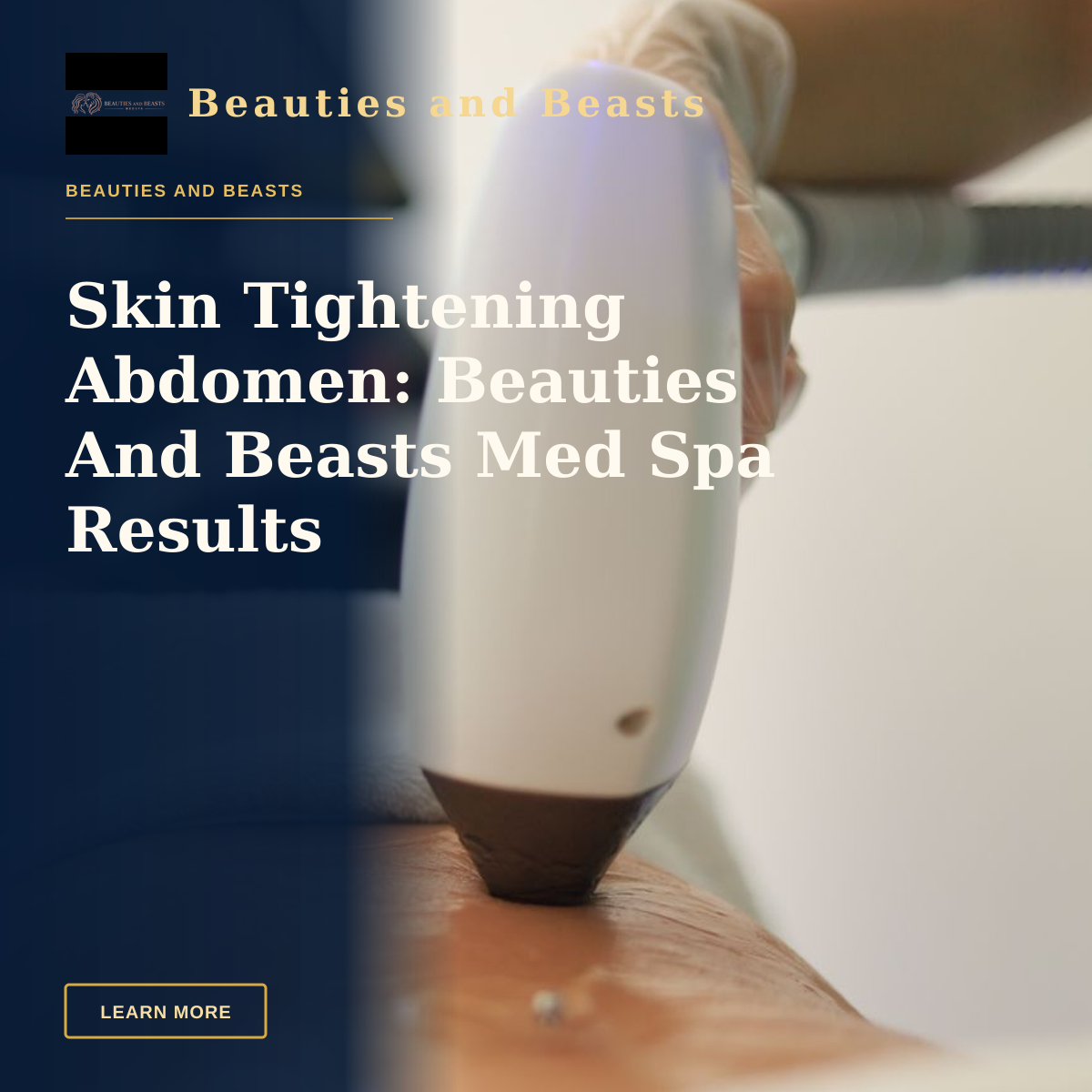Skin Tightening Abdomen: Beauties And Beasts Med Spa Results — Detailed view of a laser treatment on skin at a medical clinic in İstanbul.