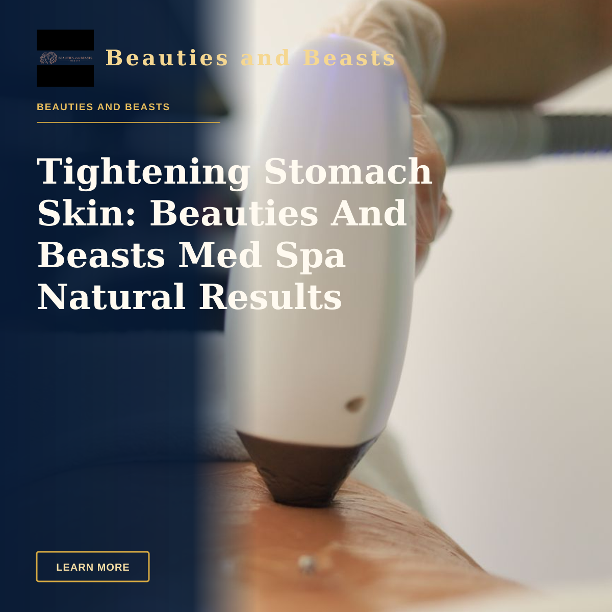 Tightening Stomach Skin: Beauties And Beasts Med Spa Natural Results — Detailed view of a laser treatment on skin at a medical clinic in İstanbul.