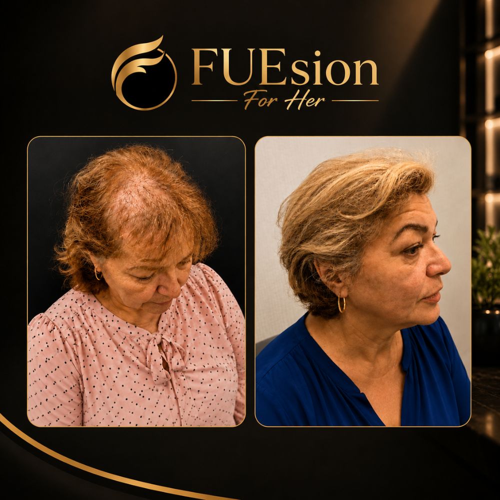 Female hair transplant before and after comparison showcasing dramatic transformation — FUEsion For Her