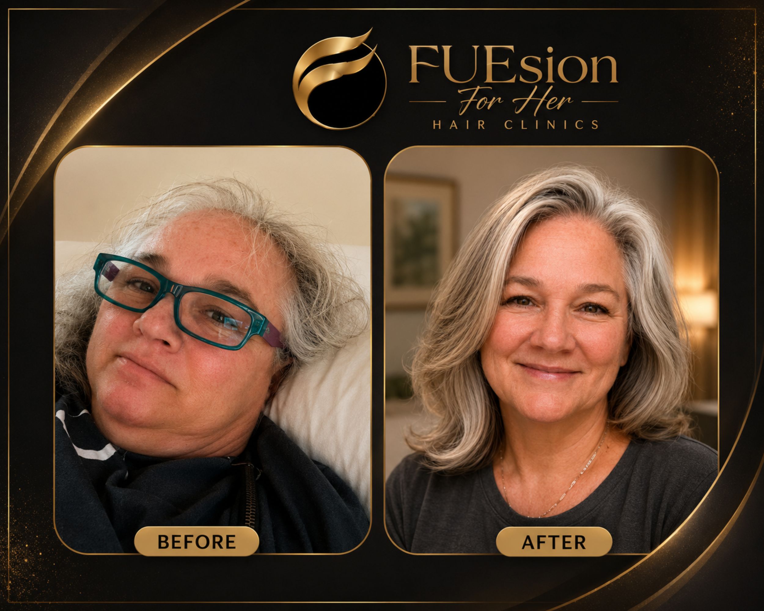 Female hair transplant before and after — overall fullness restoration showing volume improvement at FUEsion Hair Clinics